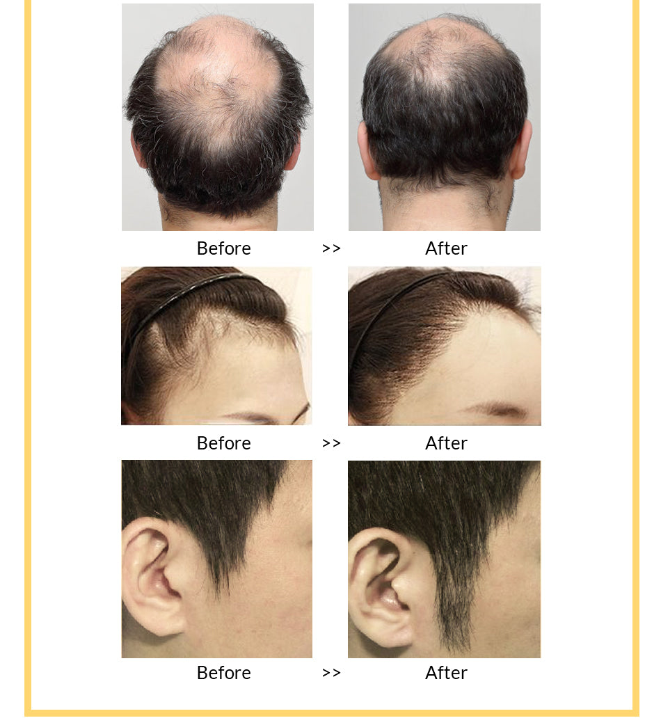 Other Men's Hair Care in USA OMY LADY Sample Free Treatment for Bald Hair Regrowth Serum