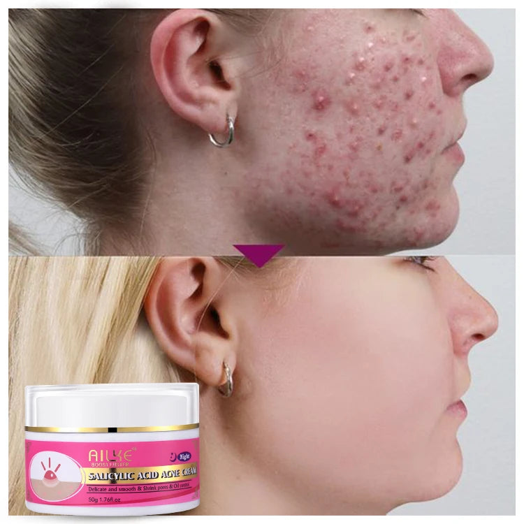 Best Beauty Face & Body Care Salicylic Acid Acne Cream Whitening Plus Lotion Carotene Serum Oil Remove Dark Spots Skin Care Set