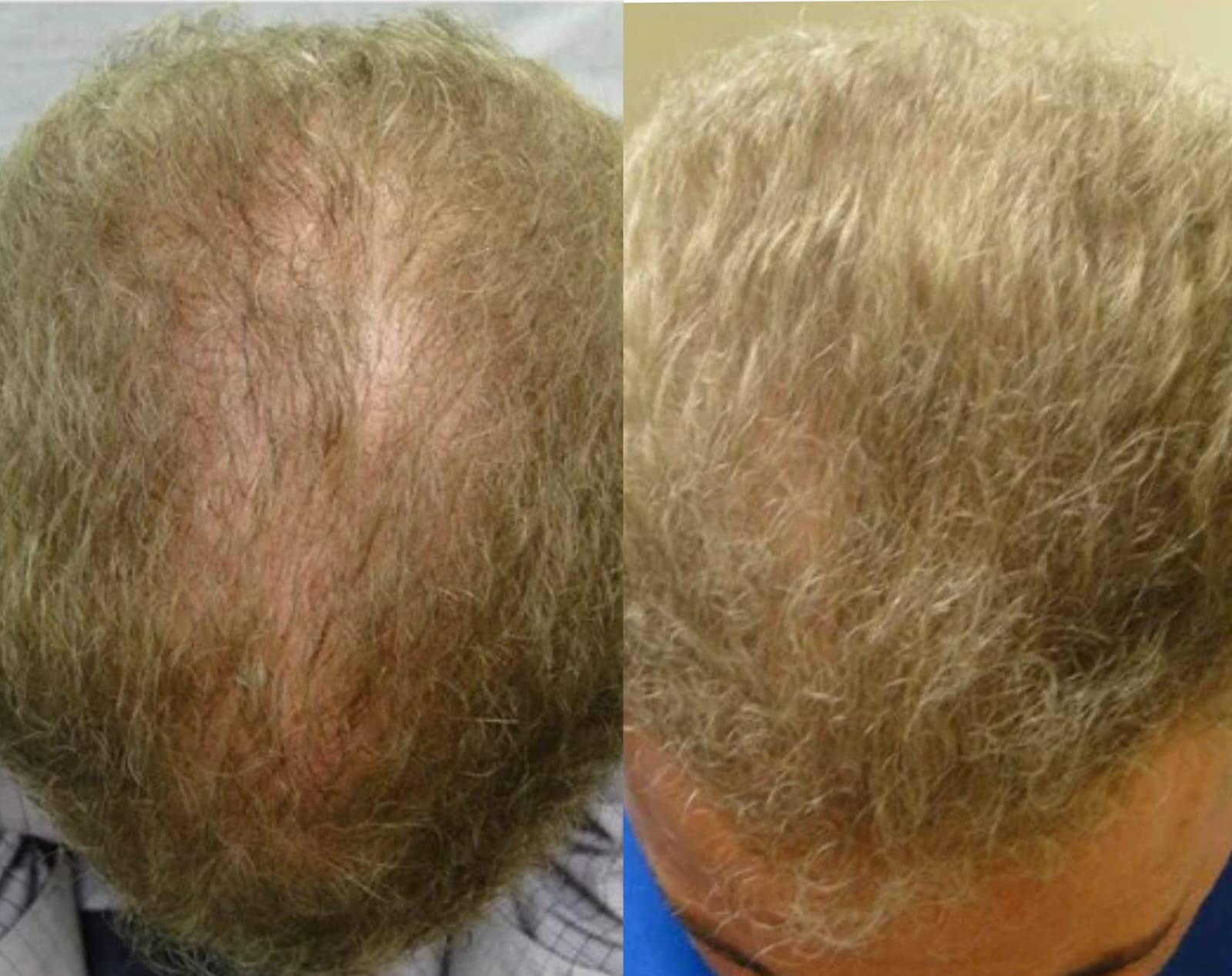 Hair Regrowth Oil - My Store
