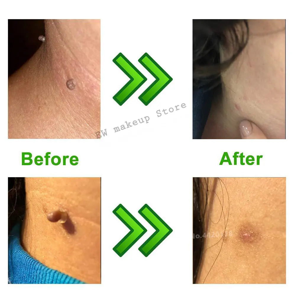 Micro Skin Tag Remover Remover Patch Mole Remover Kit Remove Acne Pimple Treatments Cleansing Swabs  Face Skin Care Beauty