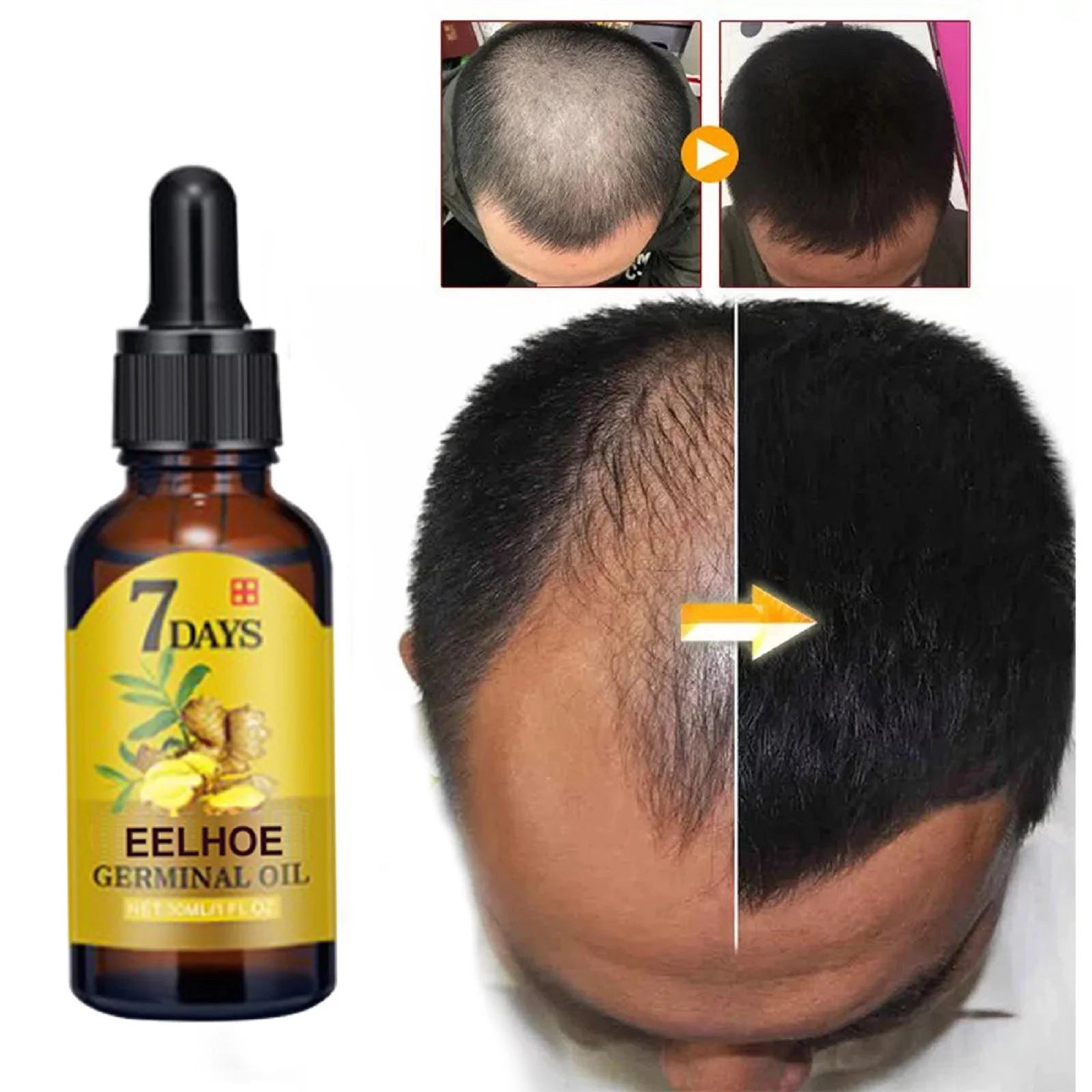 Ginger Hair Care Oil Hair Roots Scalp Treatment Improve Androgenetic Alopecia Scalp Treatment Serum Strengthen Hair Roots